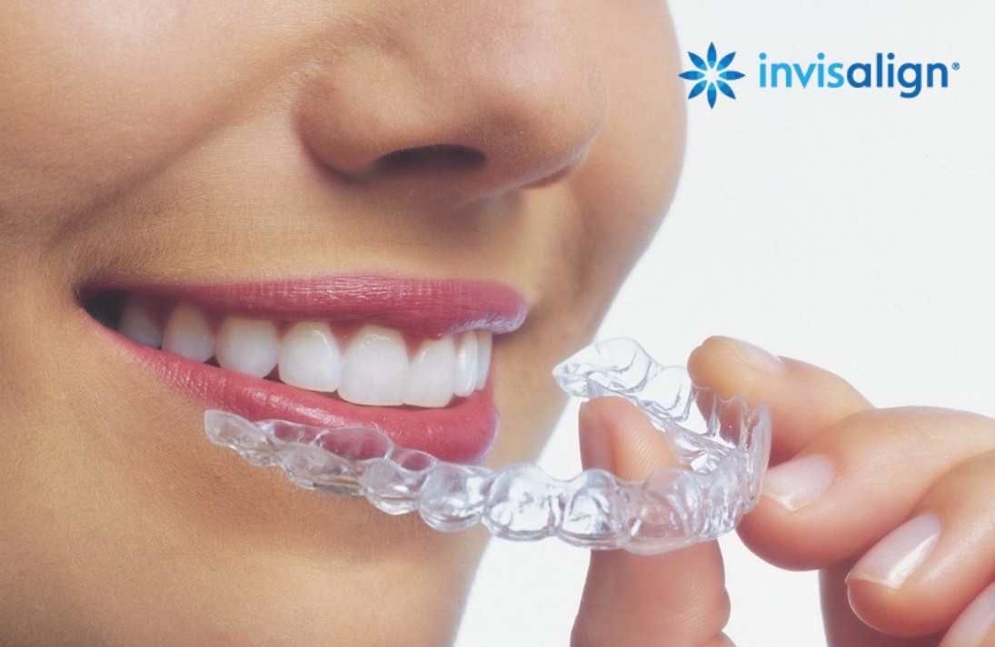 invisalign-image-1