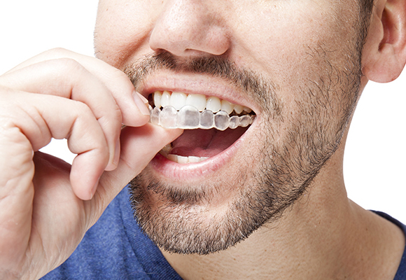 man wearing invisalign
